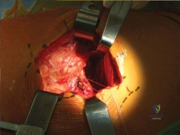 صورة طبية: استبدال مفصل الورك الكلي الناجح في خلل التنسج النمائي للورك: دليل شامل من الأستاذ الدكتور محمد هطيف