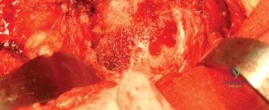 صورة طبية: النهج الخلفي الجانبي المتقدم: تحقيق أفضل النتائج في جراحة استبدال مفصل الورك الكلي مع الأستاذ الدكتور محمد هطيف في صنعاء