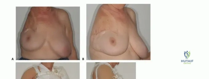 صورة توضيحية لـ بتر الربع الأمامي: كل ما يجب أن تعرفه عن هذا الإجراء المعقد
