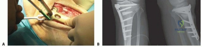 صورة طبية: قطع عظم الظنبوب العالي: إعادة محاذاة الركبة لتخفيف دائم لآلامها مع الأستاذ الدكتور محمد هطيف