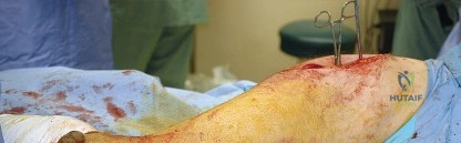 صورة توضيحية لـ النهج الخلفي لمفصل الورك: دليل شامل لاستعادة الحركة في صنعاء مع الأستاذ الدكتور محمد هطيف