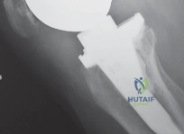 صورة طبية: إتقان موازنة الفجوة في مراجعة استبدال مفصل الركبة: تجنب الأخطاء الشائعة واستعادة الحركة مع الأستاذ الدكتور محمد هطيف