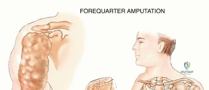 صورة شعاعية توضح حالة معقدة في العظام