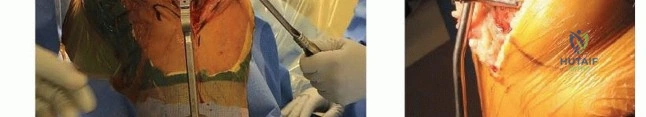 صورة توضيحية لـ جراحة استبدال مفصل الركبة الكلي بالأسمنت: حل دائم لتخفيف الألم واستعادة الحركة مع الأستاذ الدكتور محمد هطيف في صنعاء