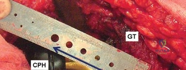 صورة طبية: إتقان توازن الأنسجة الرخوة لمفصل ورك صناعي مثالي: دليل شامل للمرضى مع الأستاذ الدكتور محمد هطيف