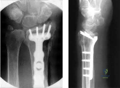 صورة طبية: دليل شامل لكسور وإصابات الجهاز الحركي: رعاية متقدمة في صنعاء مع الأستاذ الدكتور محمد هطيف