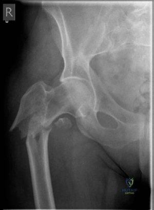 Illustration 5 for Lower Limb Trauma: Decipher Anteroposterior (AP) Figure for Exams