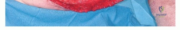 صورة طبية: استئصال ساركوما العضلة الرباعية مع الحفاظ على الطرف: دليل شامل للمرضى مع الأستاذ الدكتور محمد هطيف في صنعاء