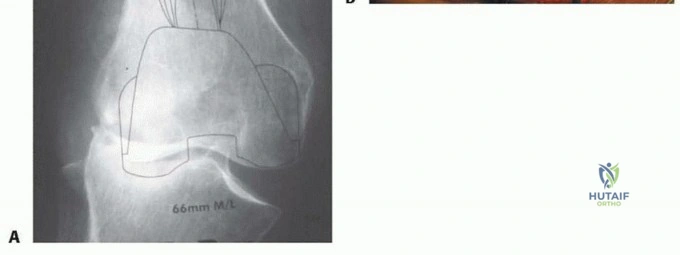 صورة لطاقم طبي يقوم بإجراء جراحة مراجعة للركبة باستخدام أجهزة متطورة