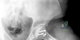 صورة طبية: جراحة تقليل رأس الفخذ المحافظة: استعادة وظيفة الورك لشباب صنعاء مع الأستاذ الدكتور محمد هطيف