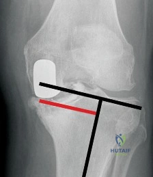 صورة توضيحية لـ التعويضات المعدنية في جراحة استبدال المفاصل فهم دورها وأهميتها