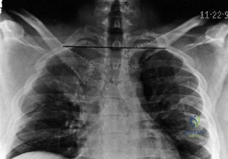 صورة طبية: دليلك الشامل لآلام الكتف: التشخيص والعلاج مع الأستاذ الدكتور محمد هطيف في صنعاء