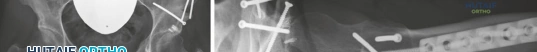صورة طبية: خلع الورك الجراحي: حل متقدم لعدم استقرار مفصل الورك المعقد في صنعاء