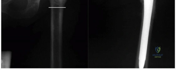 صورة طبية: سيقان مفصل الفخذ المسامية الموسعة: نجاح مثبت وتثبيت فائق لمفاصل ورك تدوم طويلاً في صنعاء مع الأستاذ الدكتور محمد هطيف