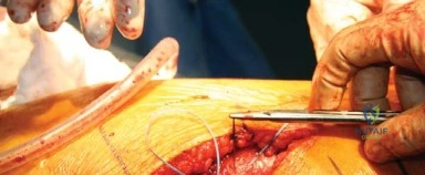 صورة طبية: النهج الخلفي الجانبي المتقدم: تحقيق أفضل النتائج في جراحة استبدال مفصل الورك الكلي مع الأستاذ الدكتور محمد هطيف في صنعاء