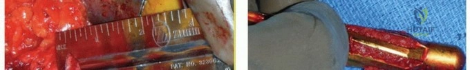 صورة توضيحية لـ مراجعة مفصل الورك: لماذا تتفوق الدعامات الأسطوانية المطلية بالمسام بشكل كامل؟