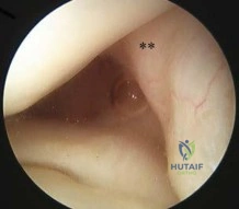 OITE & ABOS Orthopedic Board Prep: Hip, Ankle, Fracture & Arthroplasty MCQs Part 100