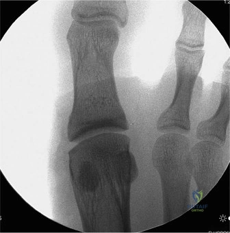 صورة توضيحية لـ تمزق الصفيحة الأخمصية في القدم: دليل شامل للتشخيص والعلاج والتعافي مع الأستاذ الدكتور محمد هطيف