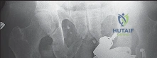 توضيح طبي: صورة رنين مغناطيسي (MRI) لمفصل الركبة تُظهر تفاصيل الأنسجة الرخوة والغضاريف
