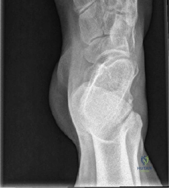 Pes Cavus Deformity & Ankle Pain: Etiology, Diagnosis, & Management for Orthopedic Professionals