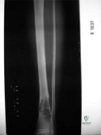 صورة توضيحية لـ الورم الليفي الغضروفي المخاطي: دليل شامل للمرضى مع الأستاذ الدكتور محمد هطيف