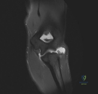 صورة طبية: آلام المرفق المعقدة: فهم وعلاج وتر الكاربوس الزندي القصير وغيرها من إصابات المرفق مع الأستاذ الدكتور محمد هطيف