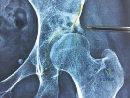 صورة توضيحية لـ خلع مفصل الورك الجراحي لعلاج الاحتكاك الفخذي الحقي: دليل شامل للمرضى