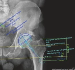 تخطيط جراحي لمفصل الورك الأيسر باستخدام برنامج TraumaCad
