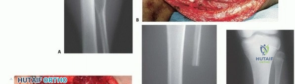 صورة طبية: استئصال أورام الشظية: دليل شامل للعلاج الحديث والحفاظ على الأطراف مع الأستاذ الدكتور محمد هطيف