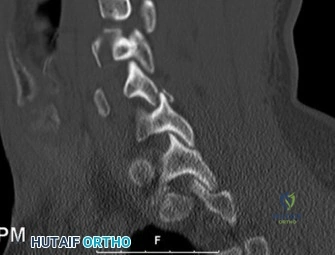 صورة توضيحية لـ دليلك الشامل لأمراض العمود الفقري: تشخيص وعلاج حالات العمود الفقري المعقدة في صنعاء