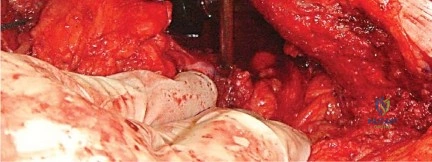 صورة طبية: إتقان توازن الأنسجة الرخوة لمفصل ورك صناعي مثالي: دليل شامل للمرضى مع الأستاذ الدكتور محمد هطيف