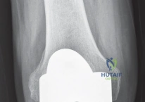 صورة طبية: استبدال مفصل الركبة بالحد الأدنى من التدخل الجراحي: ألم أقل وتعافٍ أسرع مع النهج شبه الرضفي الإنسي