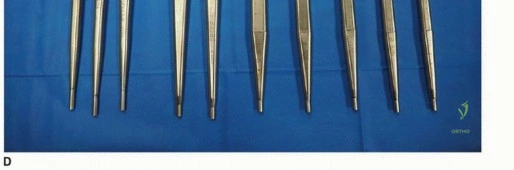 صورة طبية: مراجعة مفصل الورك بالإسمنت داخل الإسمنت: حلول متقدمة لعمليات استبدال الورك المعقدة مع الأستاذ الدكتور محمد هطيف