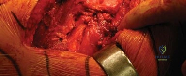 صورة طبية: النهج الخلفي الجانبي المتقدم: تحقيق أفضل النتائج في جراحة استبدال مفصل الورك الكلي مع الأستاذ الدكتور محمد هطيف في صنعاء