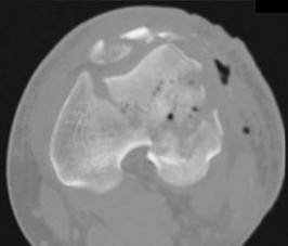 Skeletal Dysplasias of the Spine - Arab Board MCQ Prep