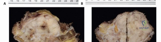 صورة طبية: جراحة أورام العجز: الحفاظ على وظائف الأمعاء والمثانة مع الأستاذ الدكتور محمد هطيف في صنعاء