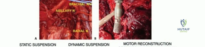 صورة طبية: استئصال الجزء القريب من عظم العضد بتقنيات الحفاظ على الطرف: دليل شامل للمرضى مع الأستاذ الدكتور محمد هطيف