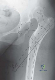 صورة طبية: استبدال مفصل الورك الكلي الناجح في خلل التنسج النمائي للورك: دليل شامل من الأستاذ الدكتور محمد هطيف