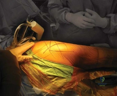 صورة توضيحية لـ المدخل الخلفي الجانبي لجراحة استبدال مفصل الورك الكلي: دليل شامل للمرضى في صنعاء مع الأستاذ الدكتور محمد هطيف