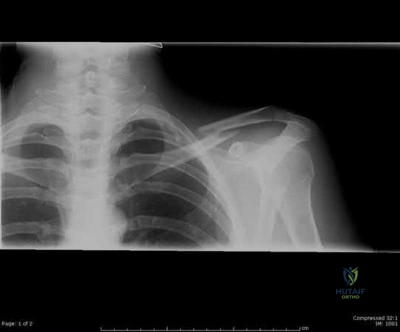 صورة طبية: دليل شامل لكسور وإصابات الجهاز الحركي: رعاية متقدمة في صنعاء مع الأستاذ الدكتور محمد هطيف