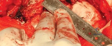 صورة طبية: المدخل الخلفي الجانبي لجراحة استبدال مفصل الورك الكلي: دليل شامل للمرضى في صنعاء مع الأستاذ الدكتور محمد هطيف