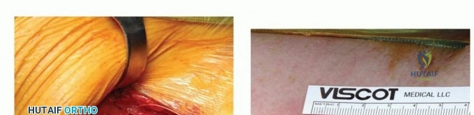 صورة طبية: تخفيف الانحشار الفخذي الحقي الأمامي: نهج الجراحة المفتوحة المصغرة مع الأستاذ الدكتور محمد هطيف