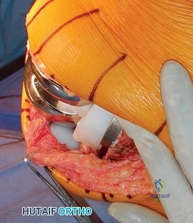 صورة طبية: إتقان موازنة الفجوة في مراجعة استبدال مفصل الركبة: تجنب الأخطاء الشائعة واستعادة الحركة مع الأستاذ الدكتور محمد هطيف