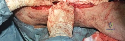 صورة طبية: جراحة استبدال مفصل الورك الملتهب في مرحلة واحدة: حل فعال وشامل مع الأستاذ الدكتور محمد هطيف