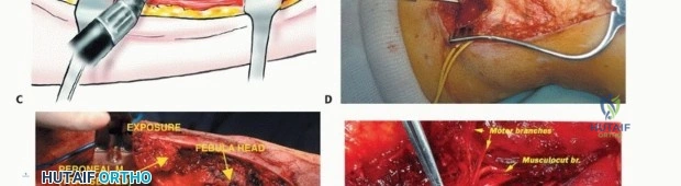 صورة طبية: استئصال أورام الشظية: دليل شامل للعلاج الحديث والحفاظ على الأطراف مع الأستاذ الدكتور محمد هطيف