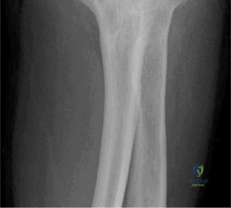 صورة طبية: آلام الكتف والمرفق: دليلك الشامل للتشخيص الدقيق والعلاج الفعال في صنعاء مع الأستاذ الدكتور محمد هطيف