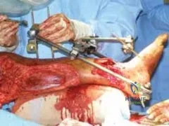 تفاصيل مرئية 25 - التثبيت الخارجي للقصبة: هكذا يتم وضع مسمارين لكسور معقدة