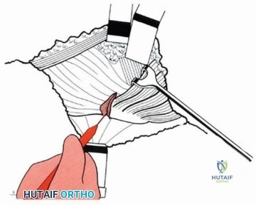 صورة طبية: قطع العظم المدوري الانزلاقي: دور حديث وتقنيات متطورة لاستعادة حركة الورك