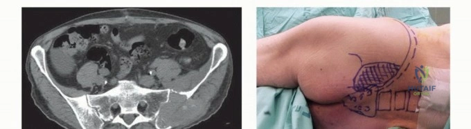 التحضير لعملية جراحية معقدة في الحوض
