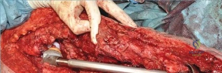 صورة طبية: جراحة استبدال مفصل الورك الملتهب في مرحلة واحدة: حل فعال وشامل مع الأستاذ الدكتور محمد هطيف